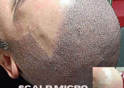Scalp Micro Pigmentation Procedures in Bangkok, Thailand