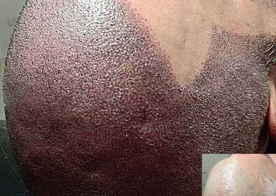 Scalp Micro Pigmentation Procedures in Bangkok, Thailand