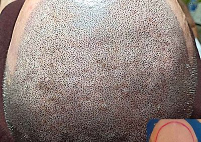 Scalp Micro Pigmentation Procedures in Bangkok, Thailand