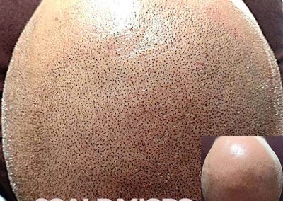 Scalp Micro Pigmentation Procedures in Bangkok, Thailand