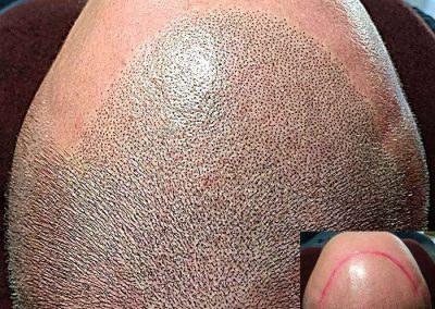 Scalp Micro Pigmentation Procedures in Bangkok, Thailand