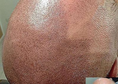 Scalp Micro Pigmentation Procedures in Bangkok, Thailand