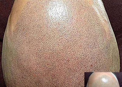 Scalp Micro Pigmentation Procedures in Bangkok, Thailand