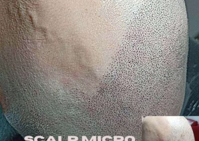 Scalp Micro Pigmentation Procedures in Bangkok, Thailand