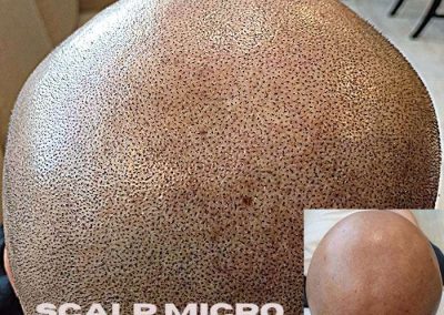 Scalp Micro Pigmentation Procedures in Bangkok, Thailand