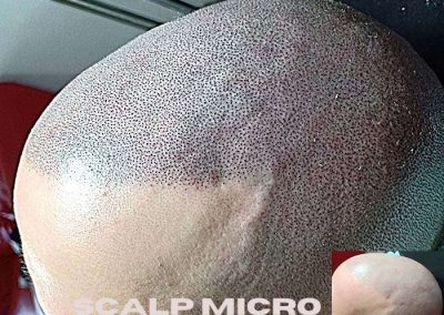 Scalp Micro Pigmentation Procedures in Bangkok, Thailand