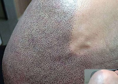 Scalp Micro Pigmentation Procedures in Bangkok, Thailand
