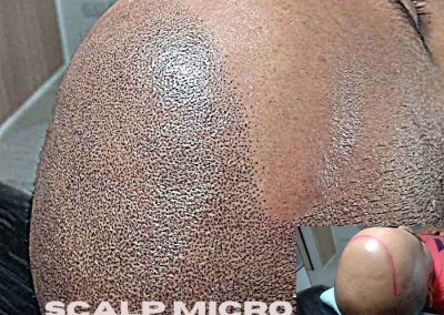 Scalp Micro Pigmentation Procedures in Bangkok, Thailand