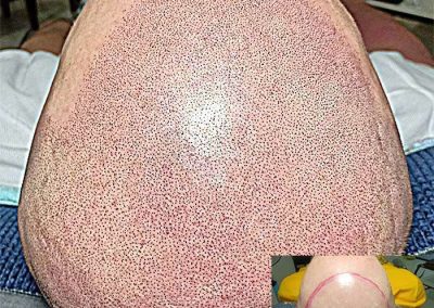 Scalp Micro Pigmentation Procedures in Bangkok, Thailand