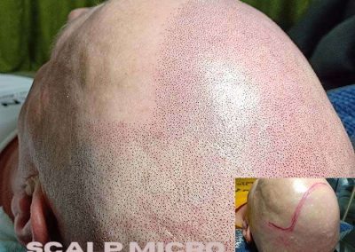 Scalp Micro Pigmentation Procedures in Bangkok, Thailand