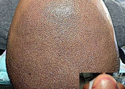 Scalp Micro Pigmentation Procedures in Bangkok, Thailand