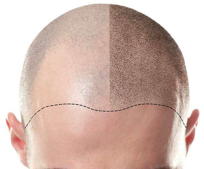 scalp-micro-pigmentation-bangkok-thailand