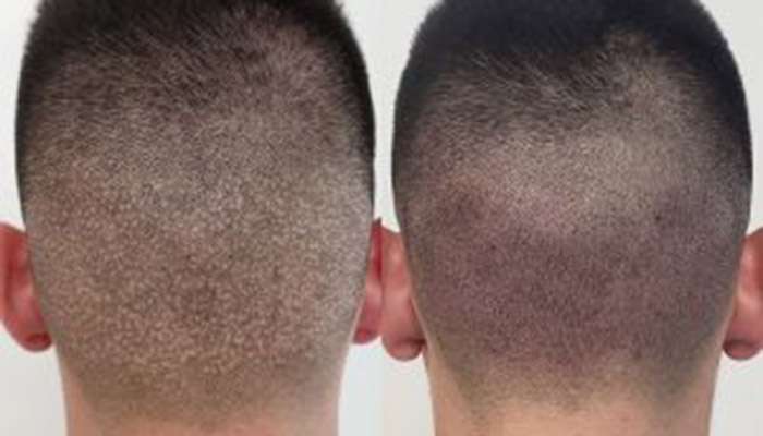 scalp-micro-pigmentation-bangkok-thailand
