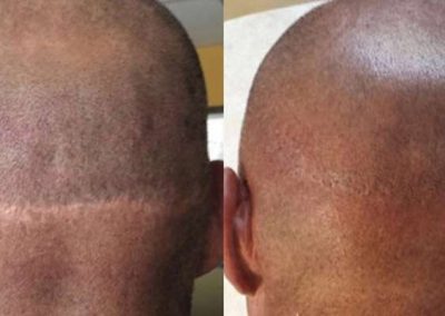 Scalp Micro Pigmentation Procedures in Bangkok, Thailand