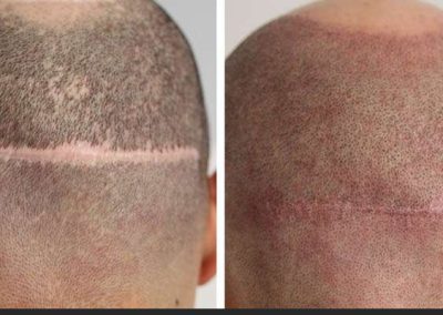 Scalp Micro Pigmentation Procedures in Bangkok, Thailand