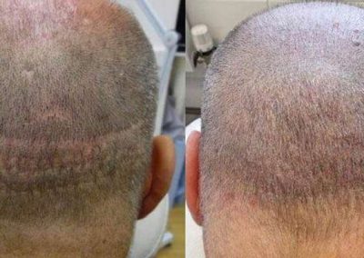 Scalp Micro Pigmentation Procedures in Bangkok, Thailand