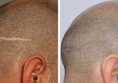 Scalp Micro Pigmentation Procedures in Bangkok, Thailand
