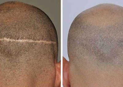 Scalp Micro Pigmentation Procedures in Bangkok, Thailand
