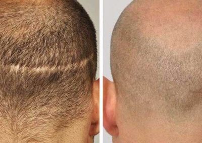 Scalp Micro Pigmentation Procedures in Bangkok, Thailand